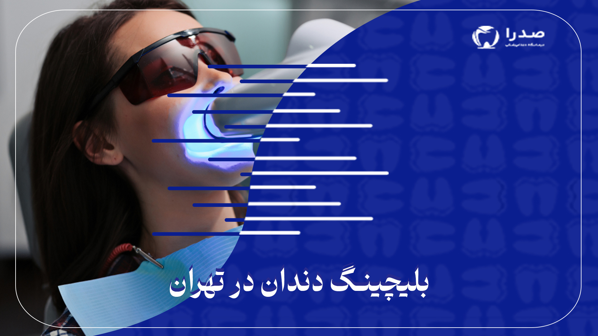 بلیچینگ دندان در تهران