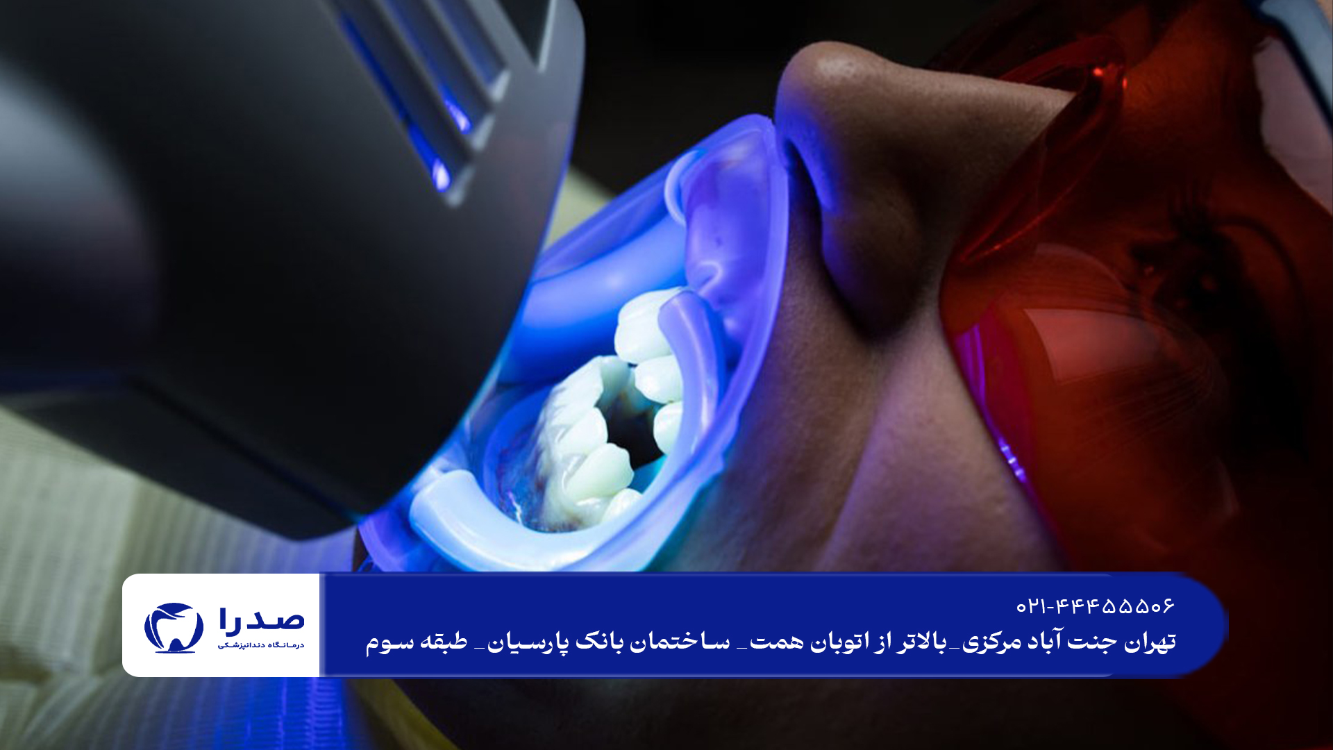 بلیچینگ دندان در تهران