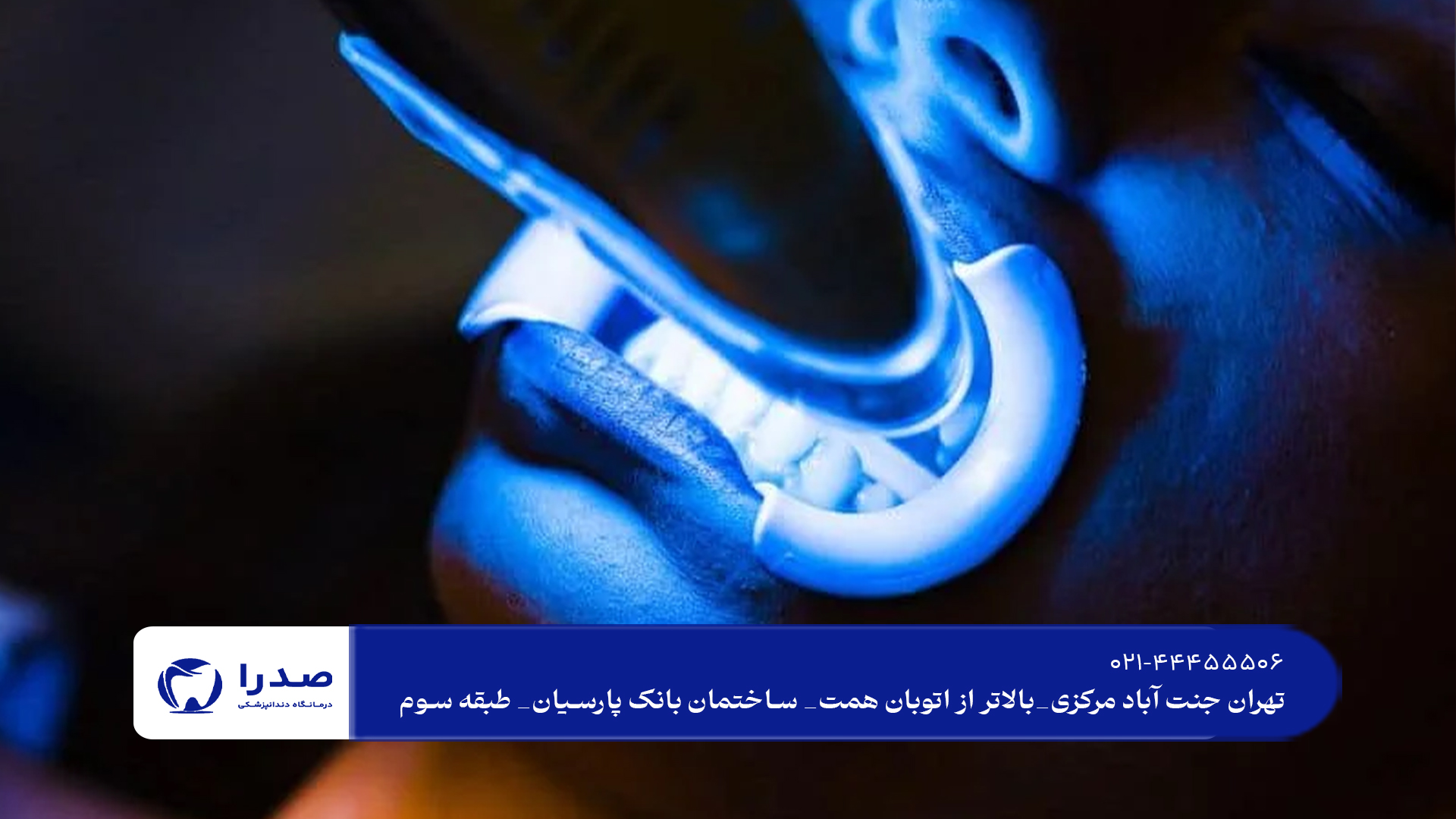 بلیچینگ دندان در تهران