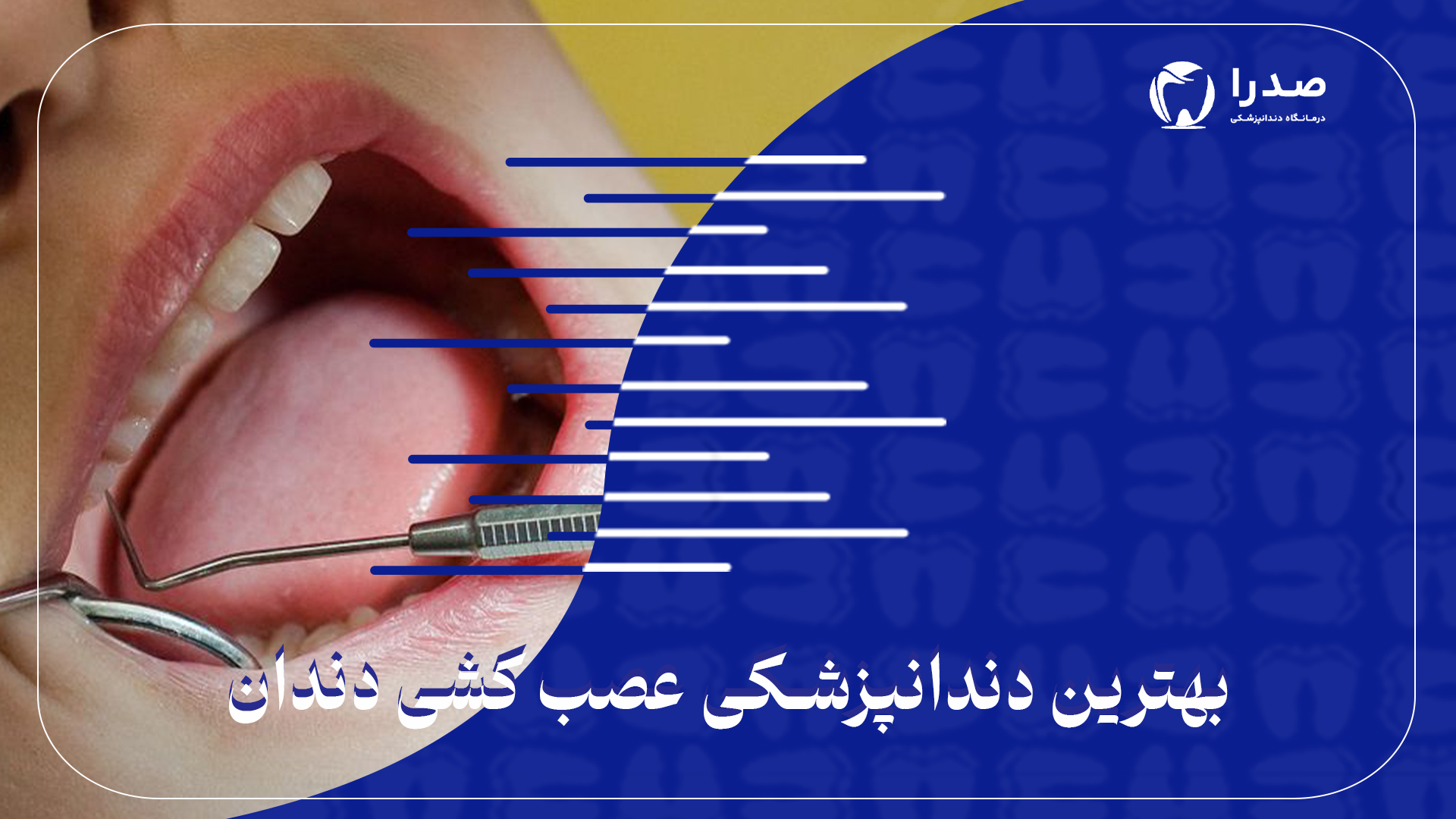 بهترین دندانپزشکی عصبکشی دندان بهترین دندانپزشکی عصبکشی دندان