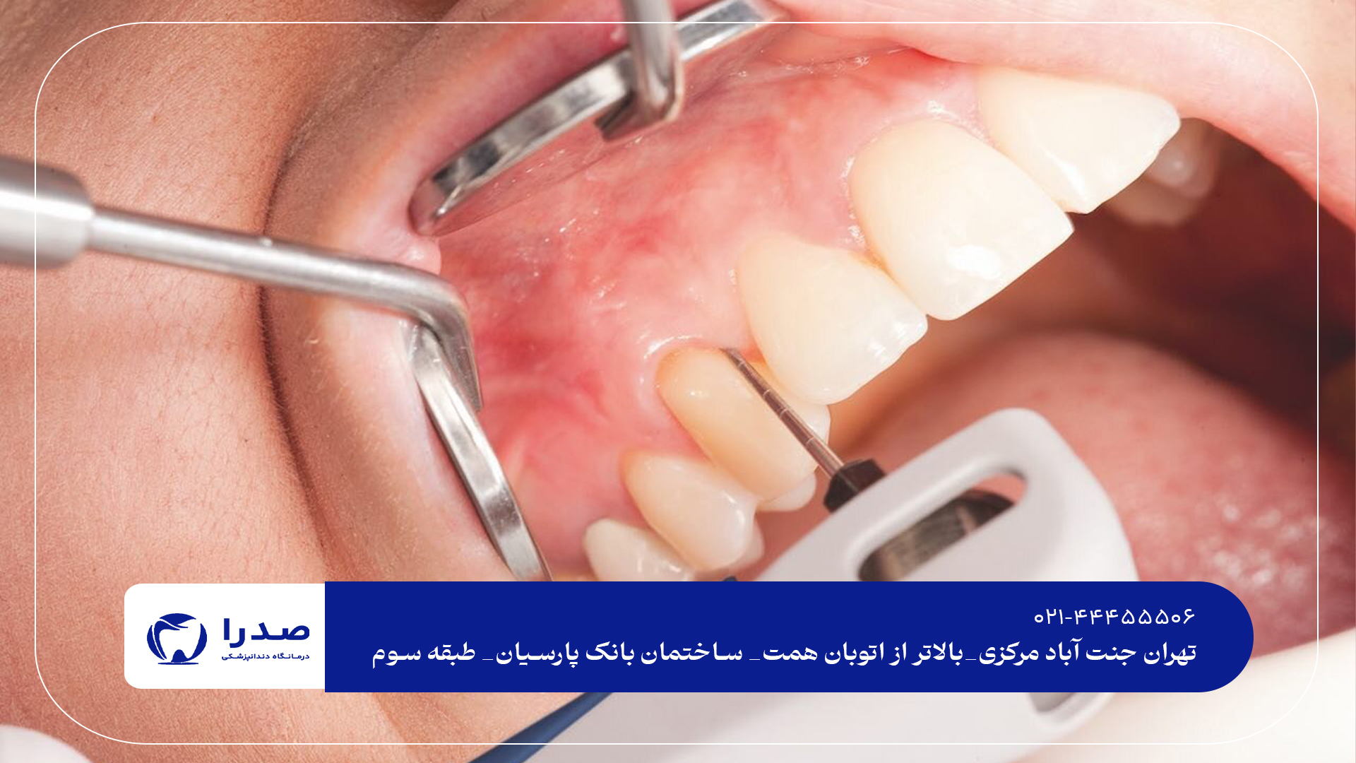 بهترین دندانپزشکی عصبکشی دندان بهترین دندانپزشکی عصبکشی دندان