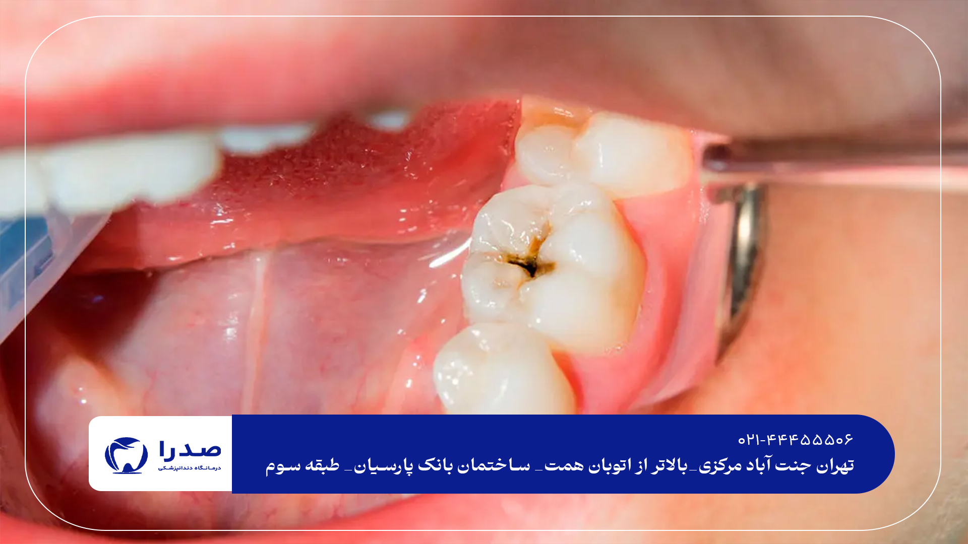 بهترین دندانپزشکی عصبکشی دندان بهترین دندانپزشکی عصبکشی دندان