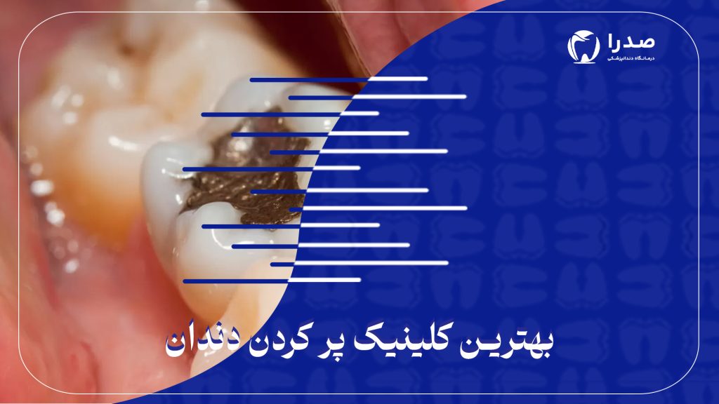 بهترین کلینیک پرکردن دندان