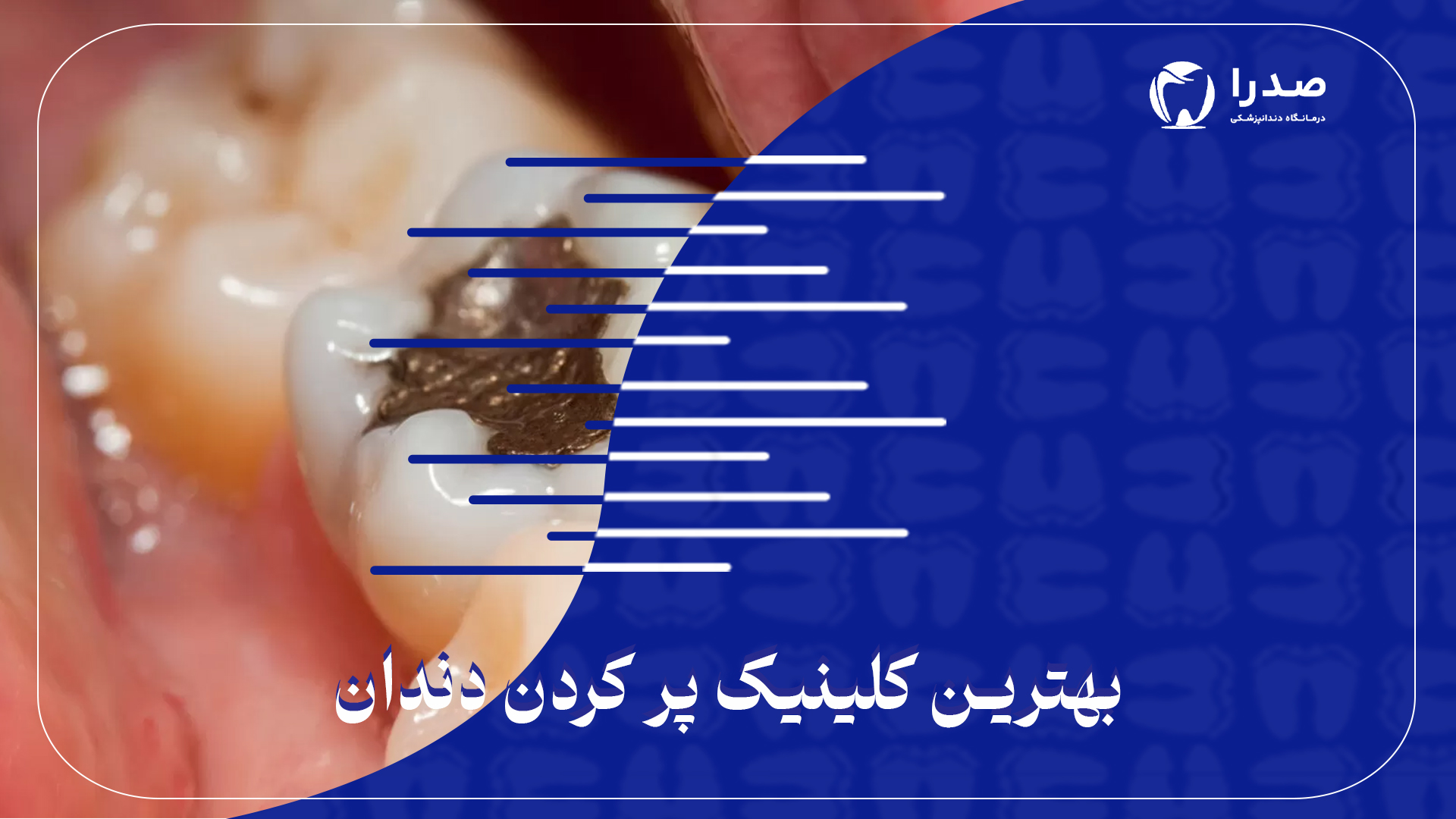 بهترین کلینیک پرکردن دندان