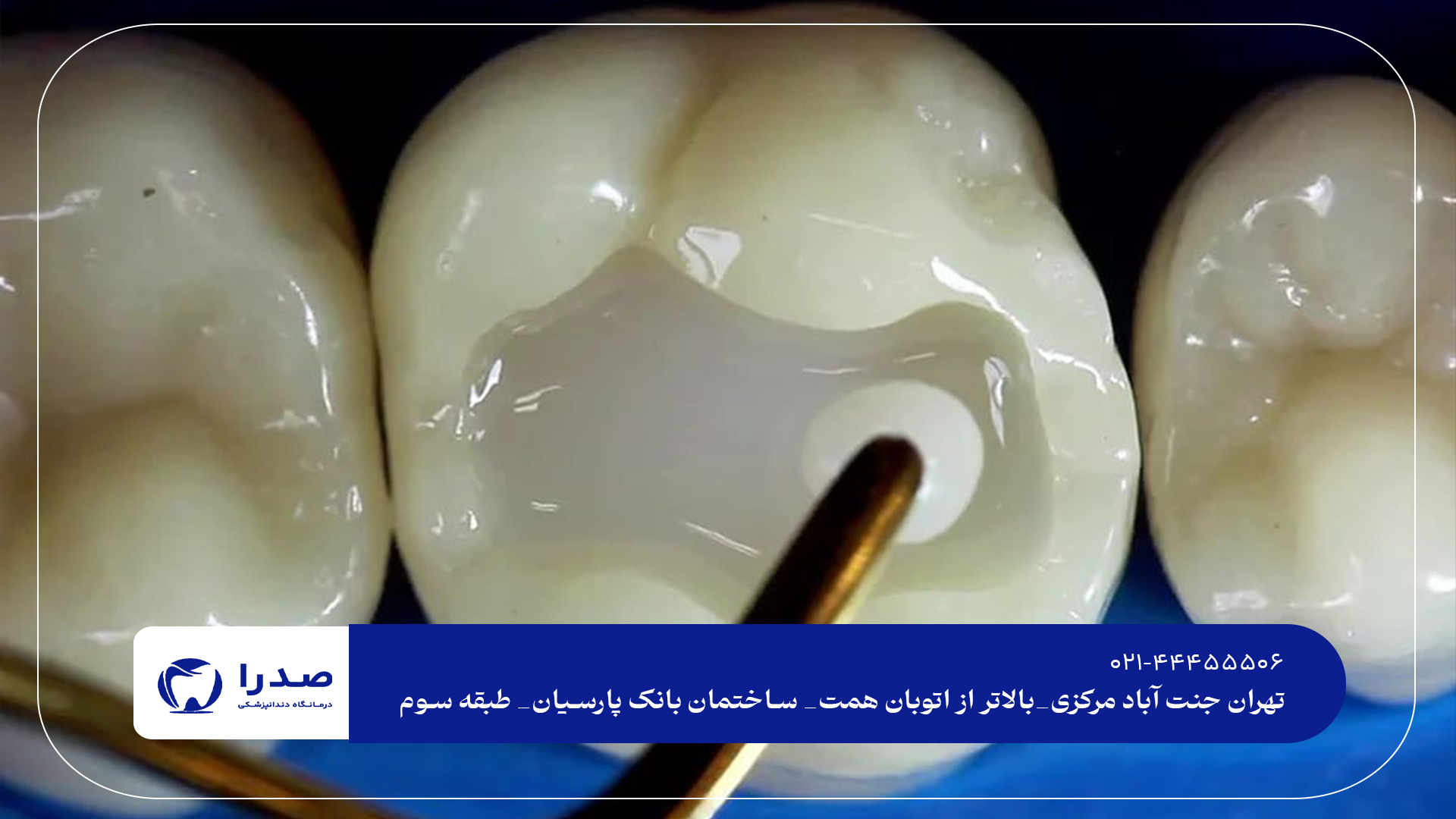 کلینیک پرکردن دندان