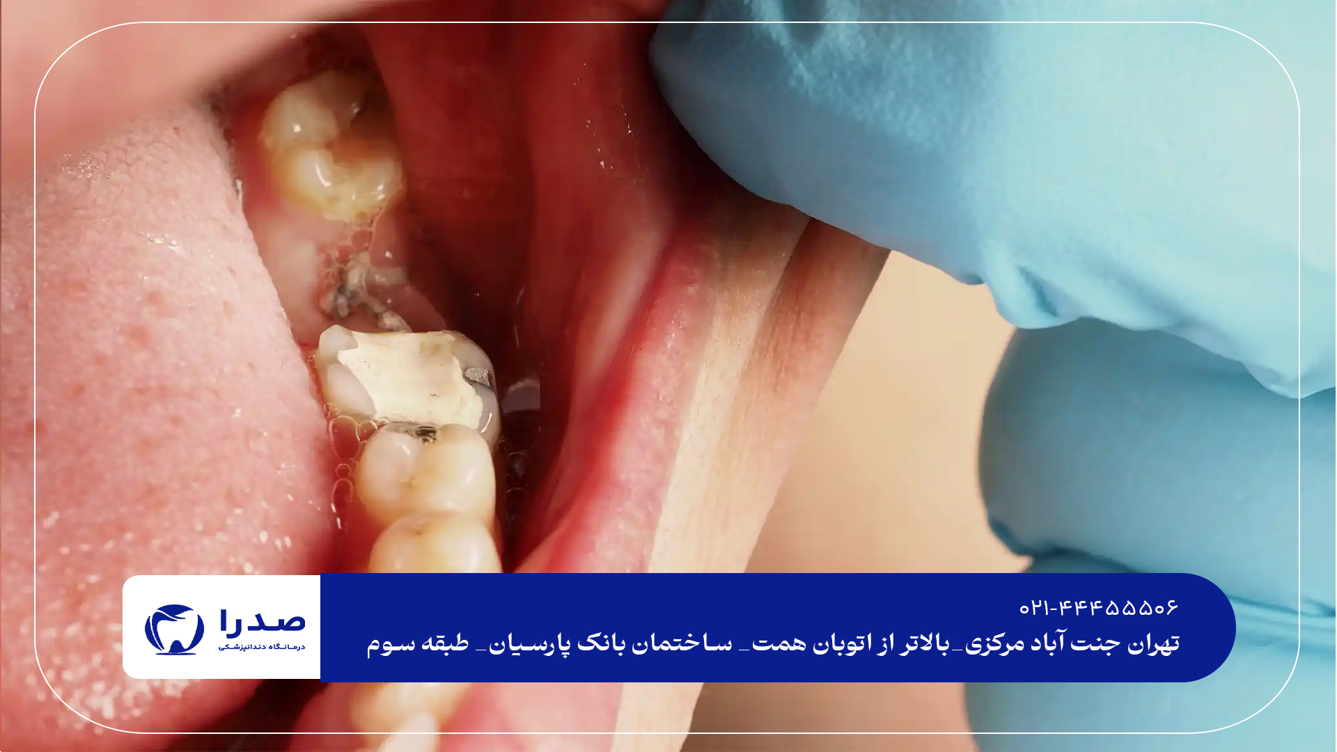 پر کردن دندان کودکان و نوجوانان