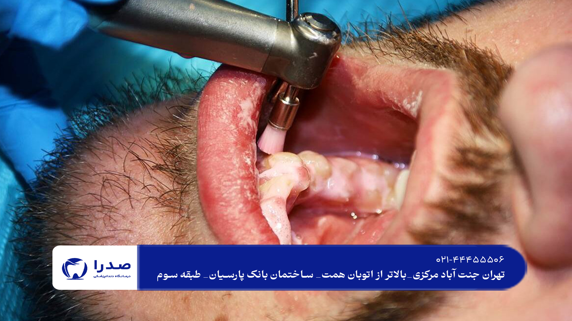 جرمگیری دندان در غرب تهران