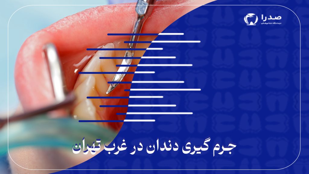 جرمگیری دندان در غرب تهران