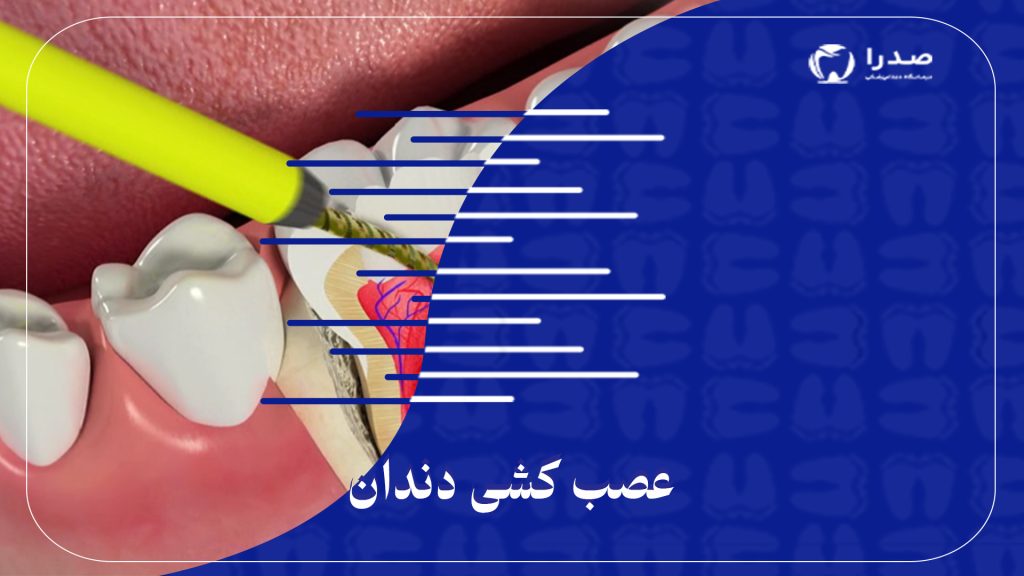 عصب کشی دندان