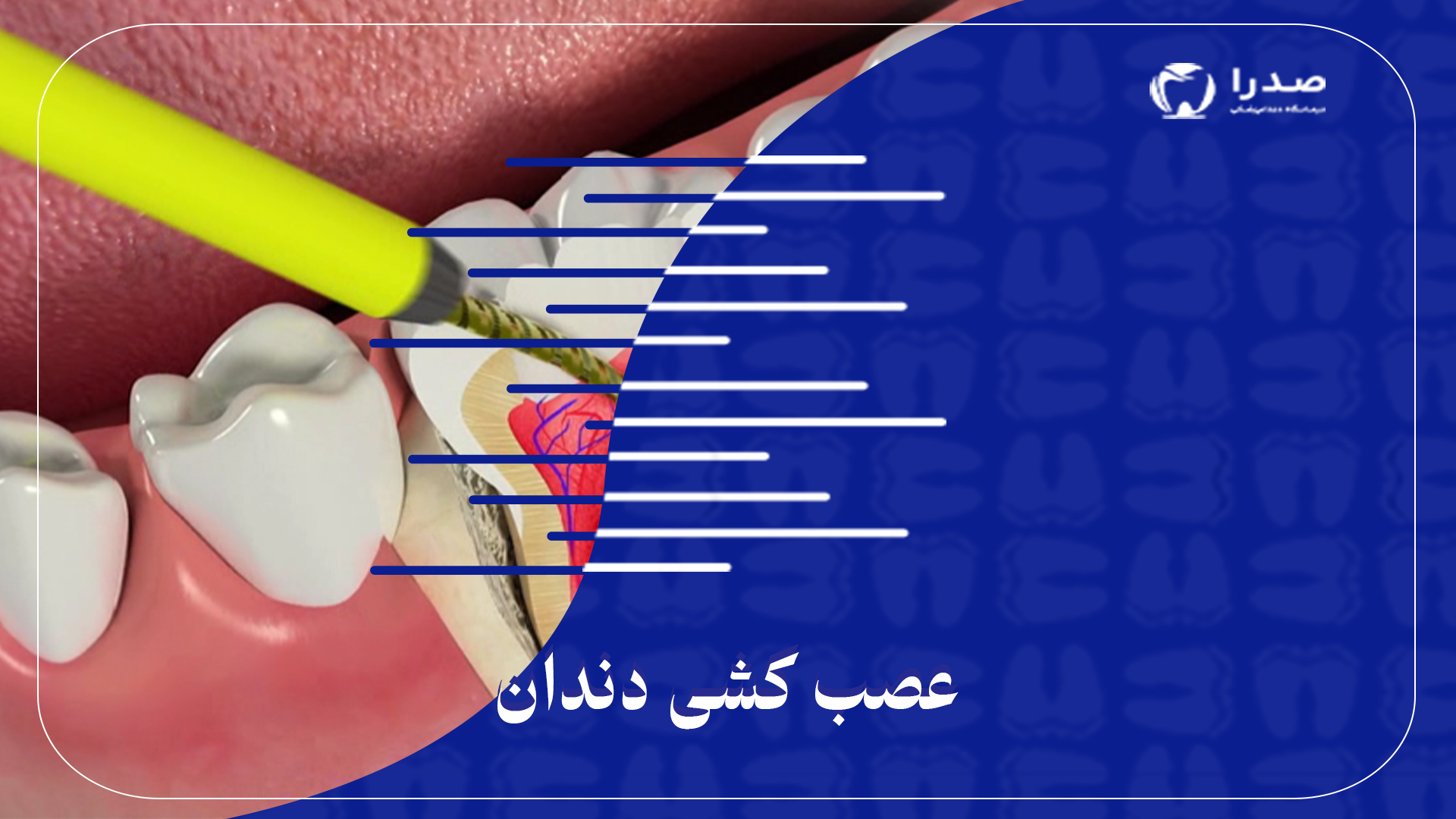 عصب کشی دندان