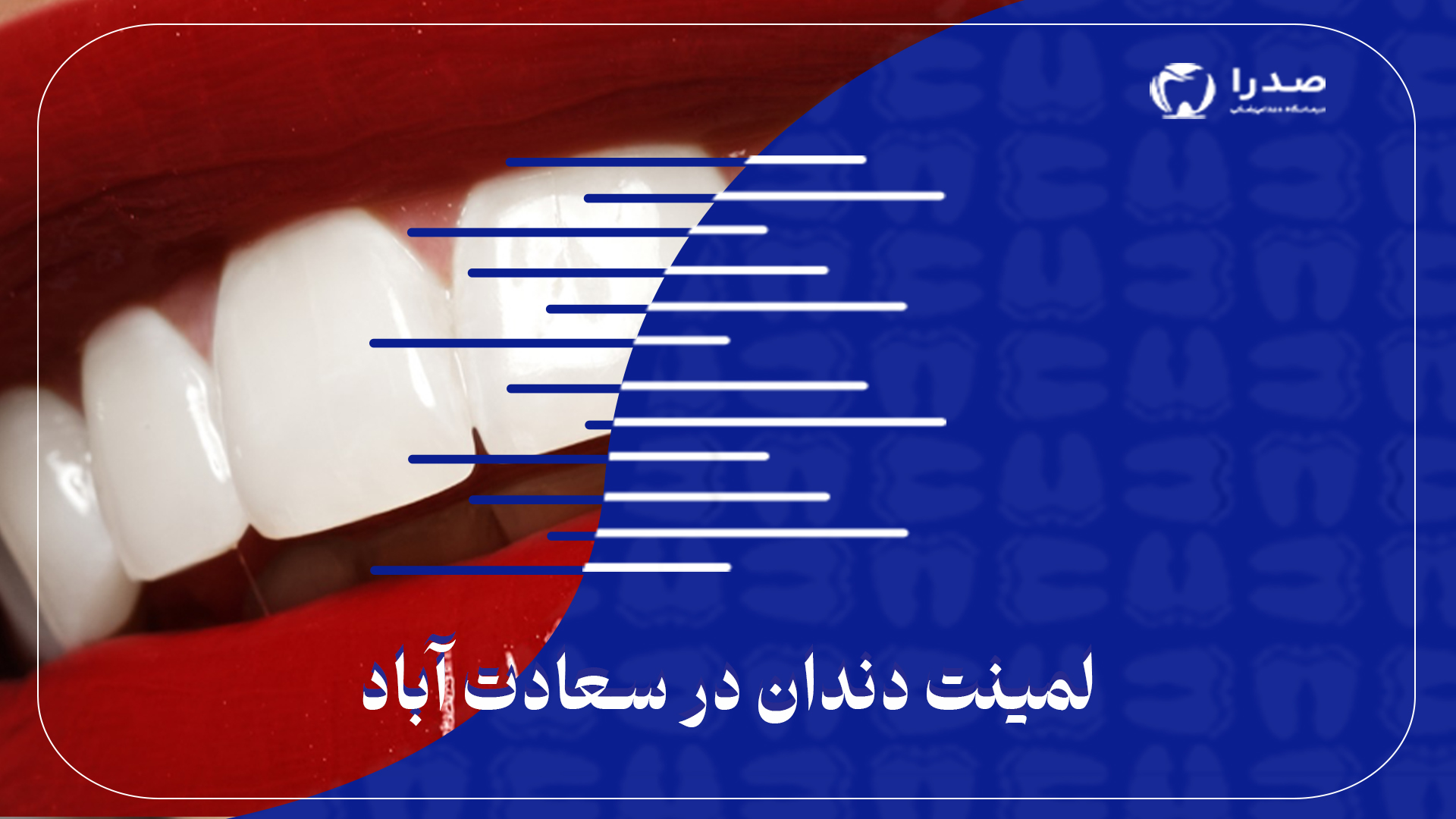 لمینت دندان در سعادت آباد
