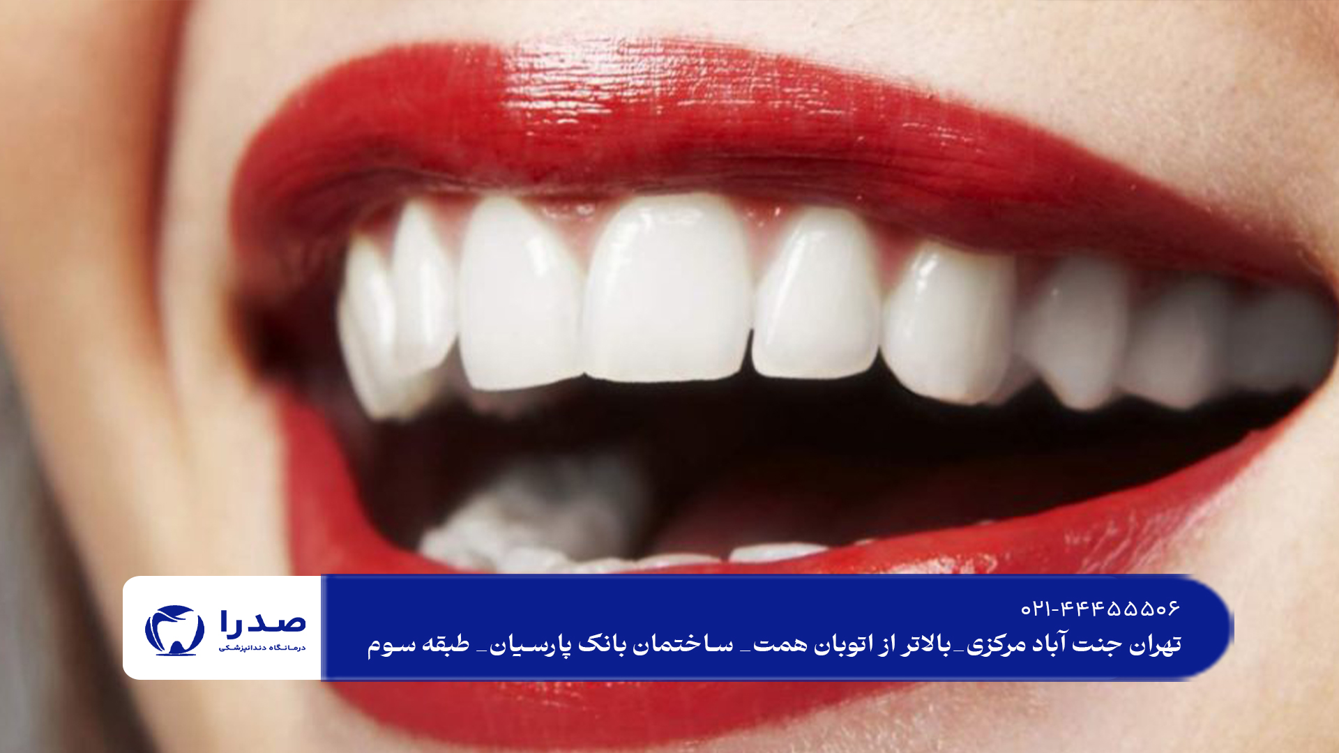 لمینت دندان در سعادت آباد