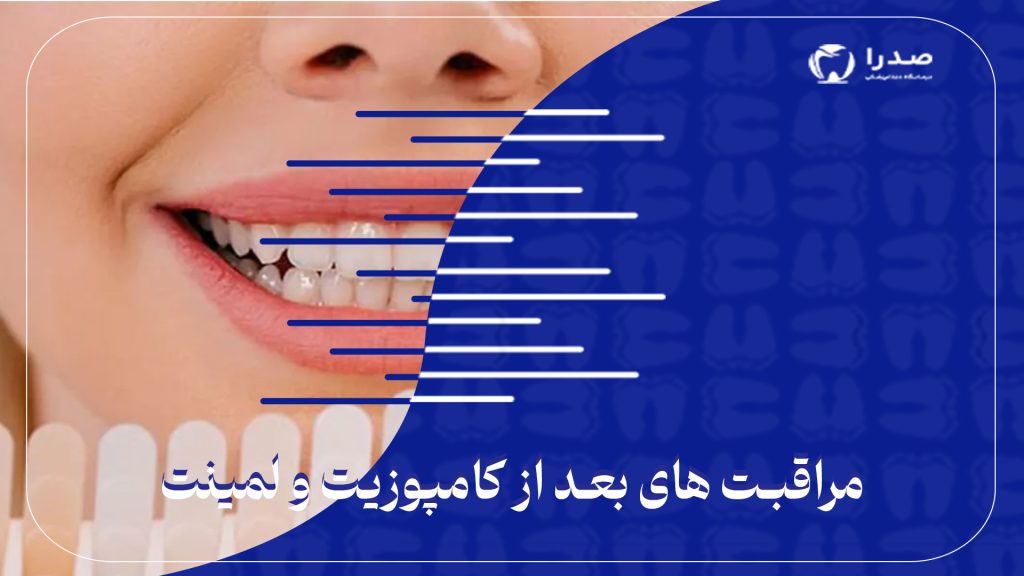 مراقبت های بعد از کامپوزیت و لمینت