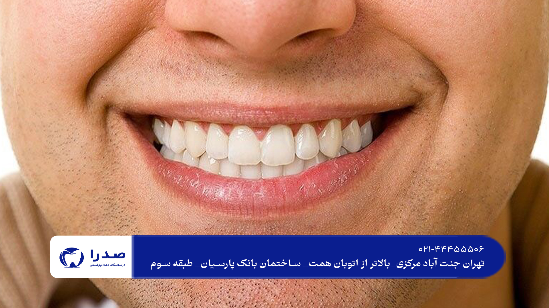 مراقبت های بعد از کامپوزیت و لمینت مراقبت های بعد از کامپوزیت و لمینت