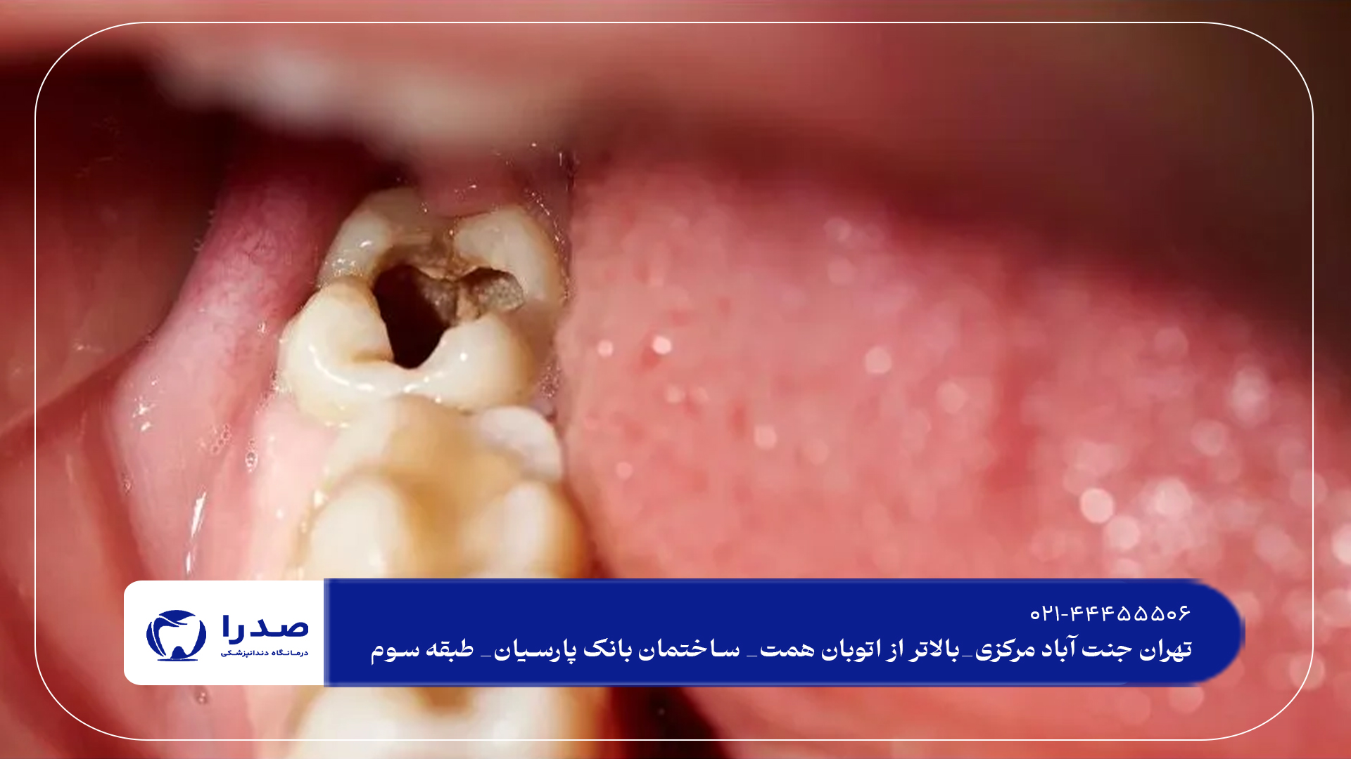 پرکردن دندان در تهران پرکردن دندان در تهران