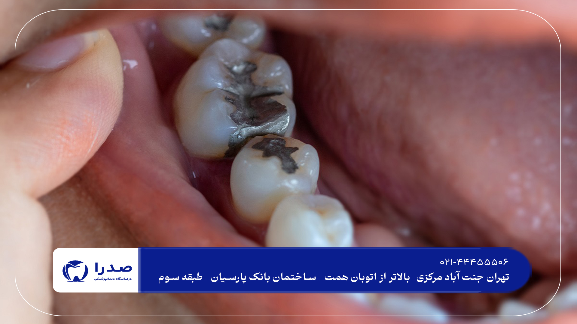 پرکردن دندان در تهران پرکردن دندان در تهران