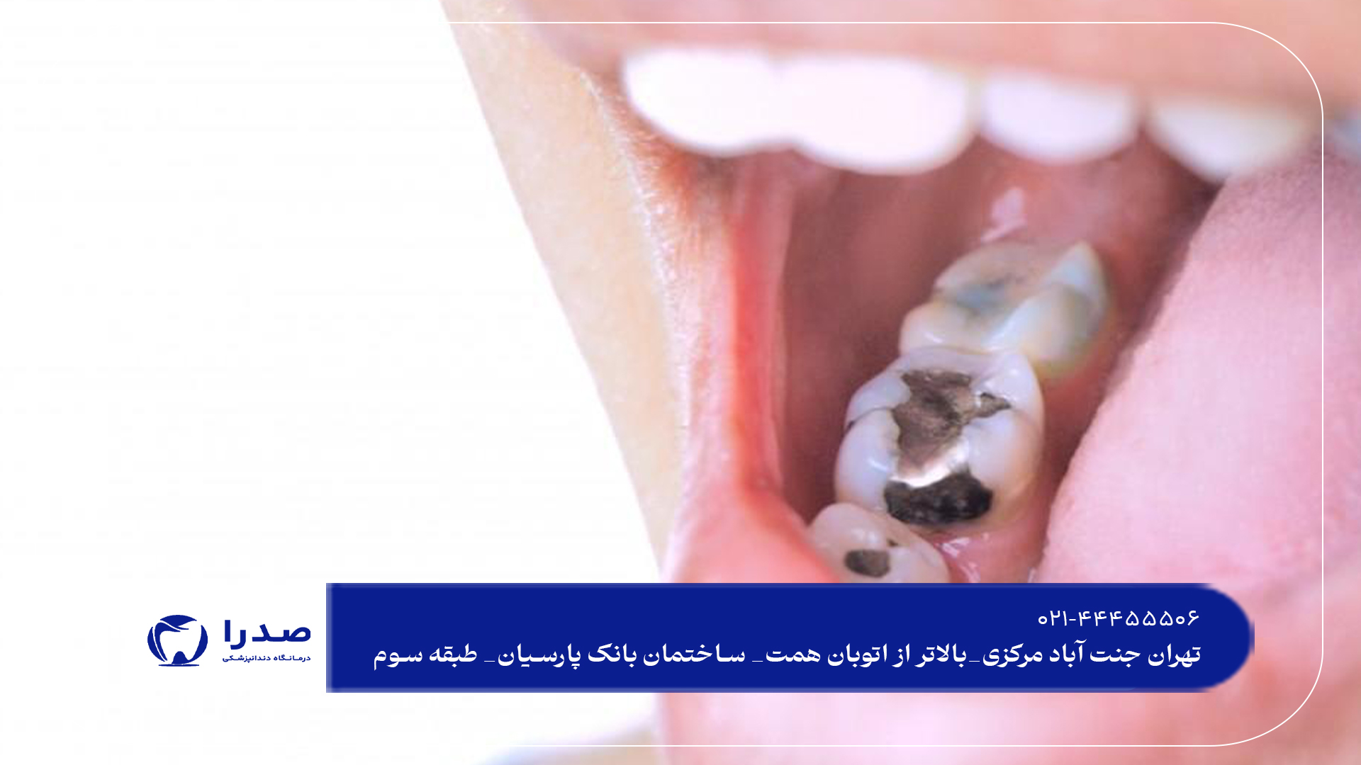 پرکردن دندان در تهران پرکردن دندان در تهران