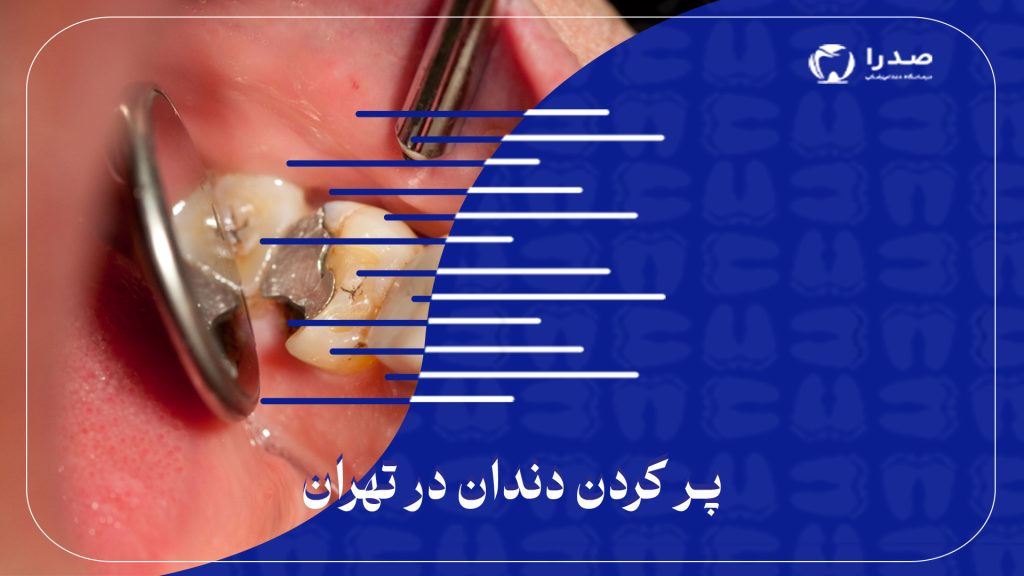 پرکردن دندان در تهران