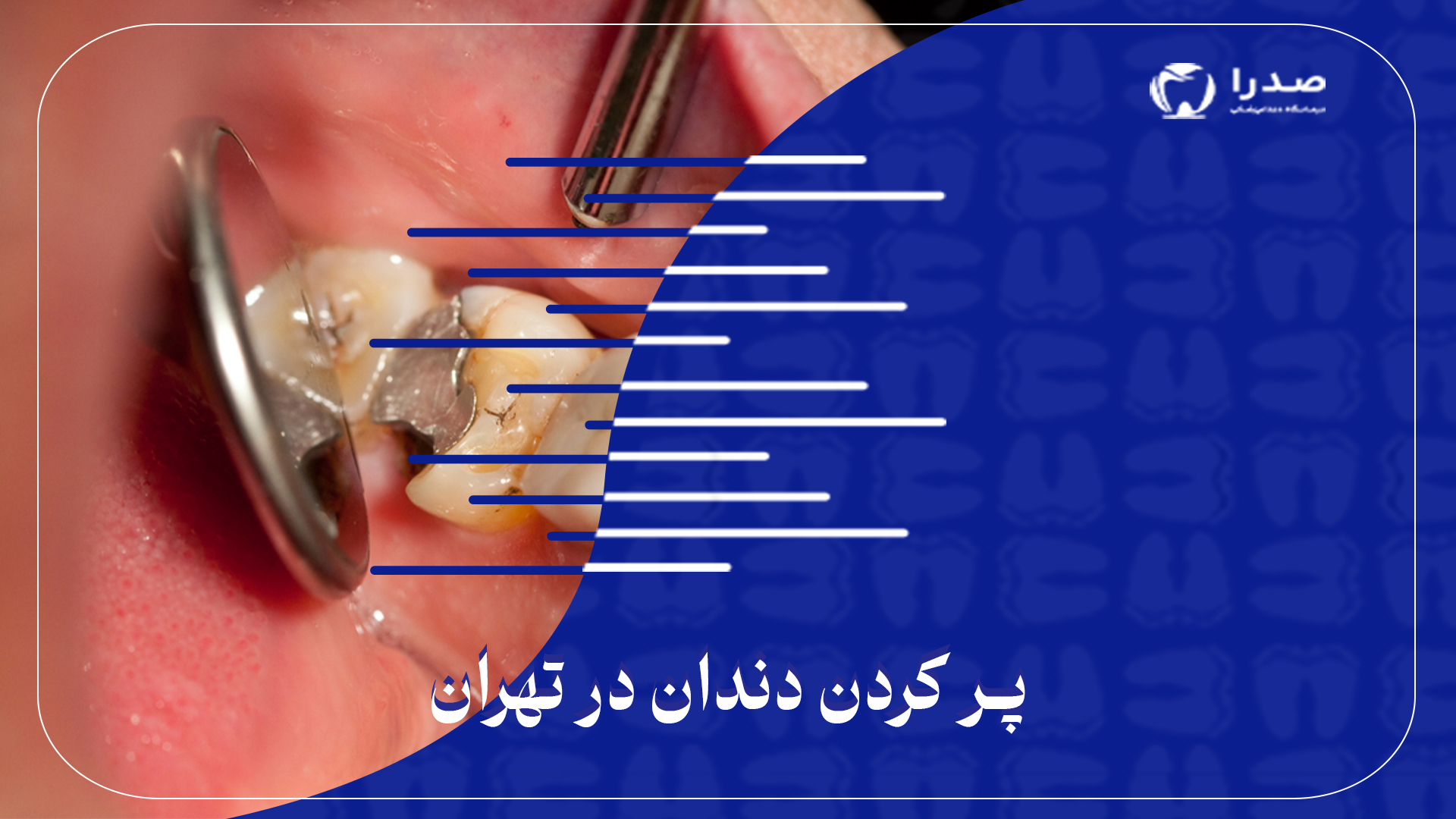 پرکردن دندان در تهران پرکردن دندان در تهران