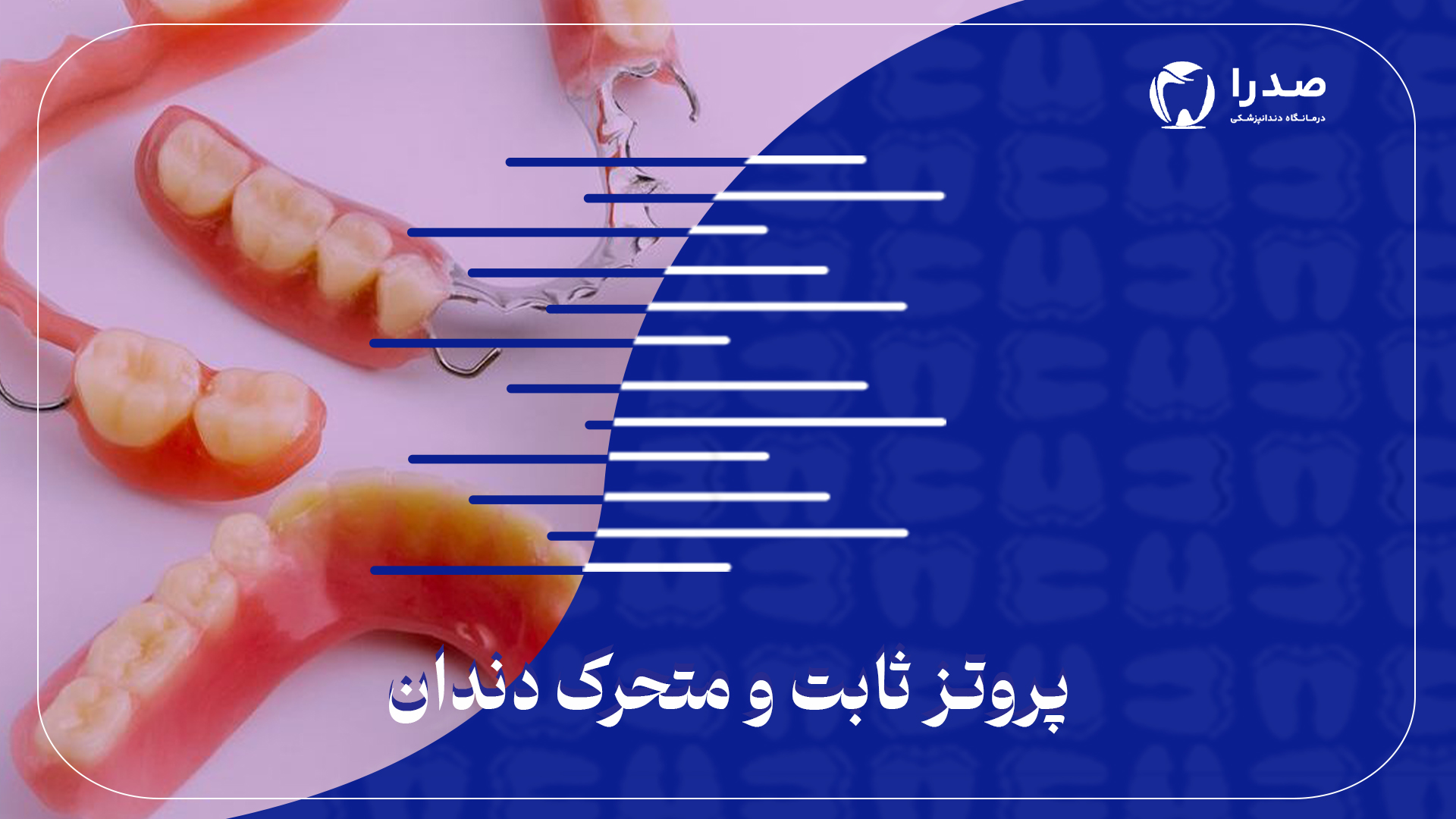 پروتز ثابت و متحرک دندان پروتز ثابت و متحرک دندان