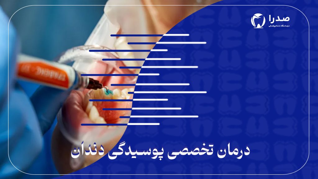 درمان تخصصی پوسیدگی دندان