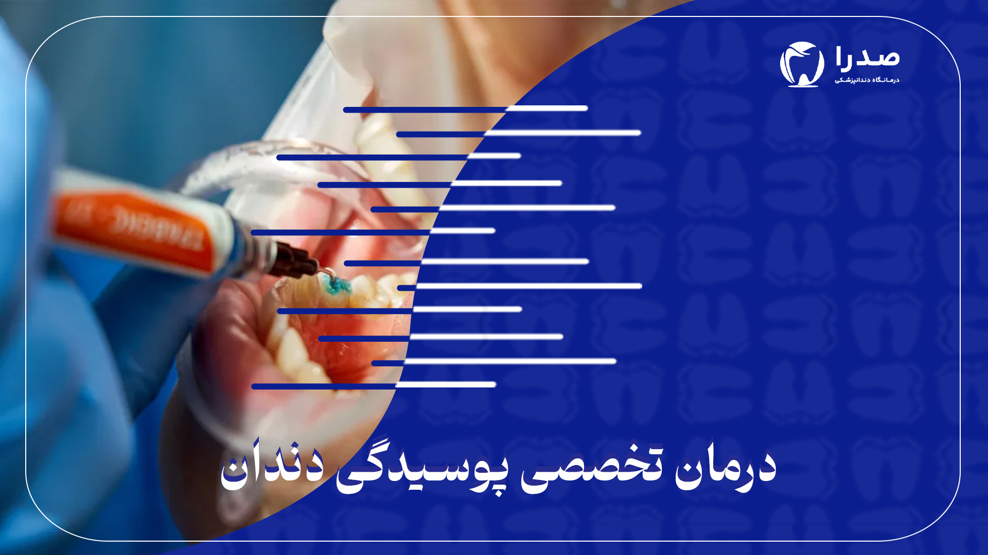 درمان تخصصی پوسیدگی دندان درمان تخصصی پوسیدگی دندان