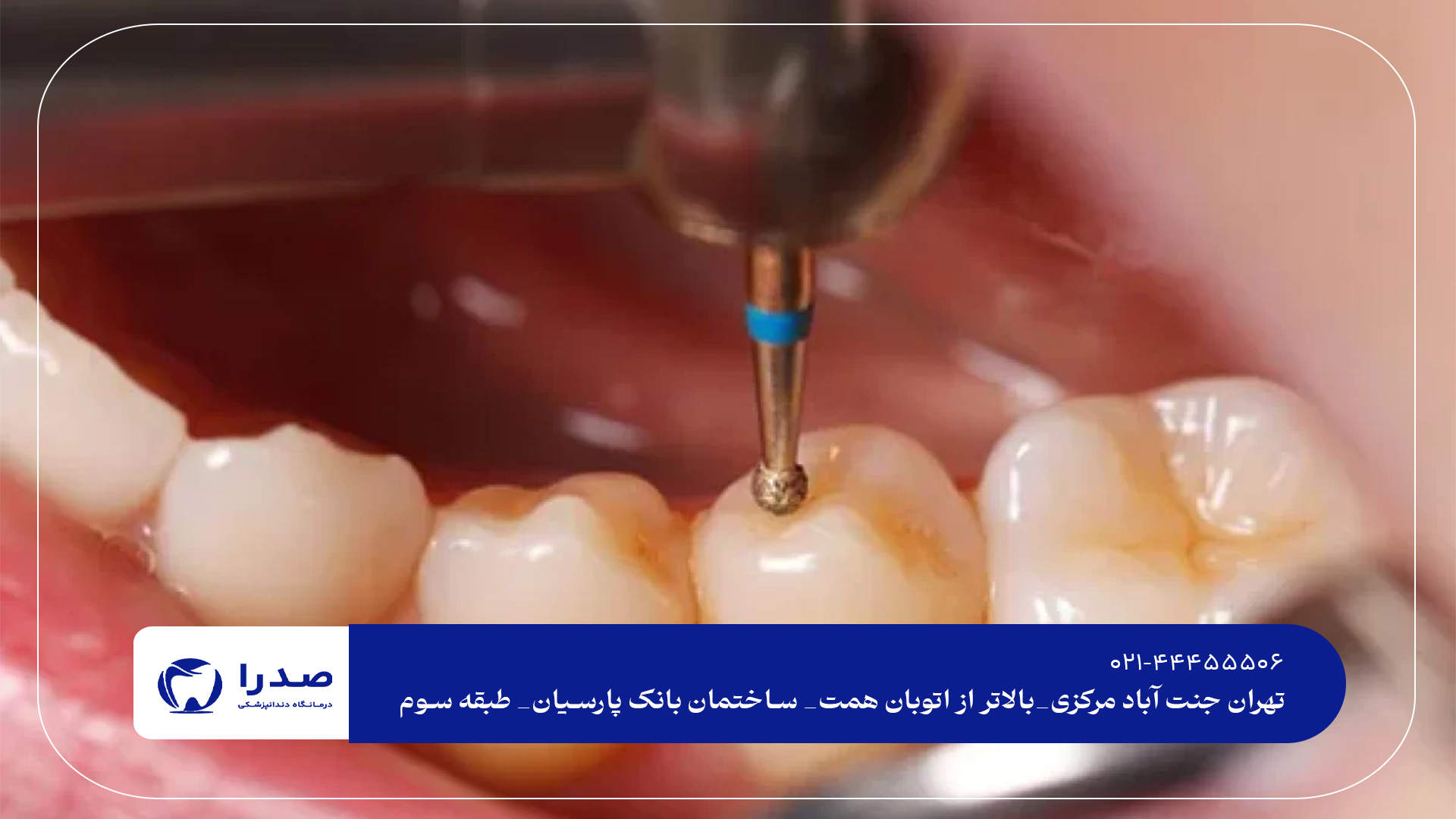 درمان تخصصی پوسیدگی دندان درمان تخصصی پوسیدگی دندان