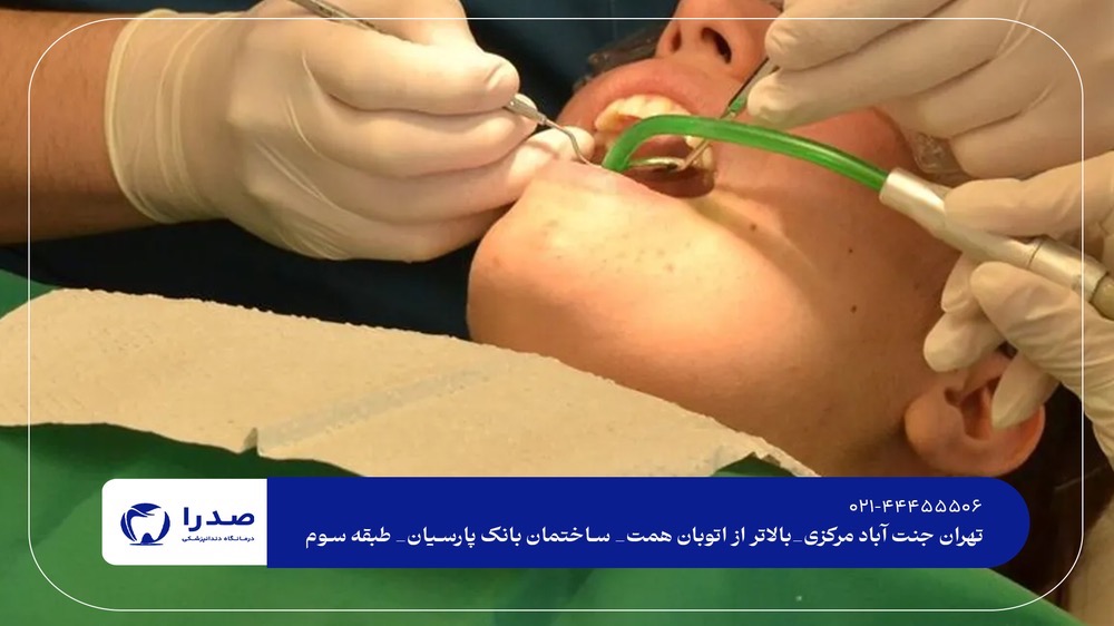 درمان ریشه دندان در مرکز تهران درمان ریشه دندان در مرکز تهران