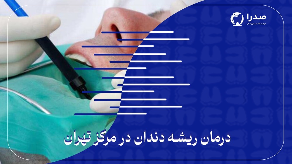درمان ریشه دندان در مرکز تهران درمان ریشه دندان در مرکز تهران