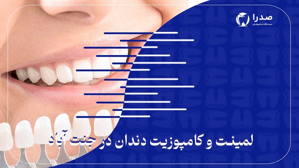 لمینیت و کامپوزیت دندان در جنتآباد لمینیت و کامپوزیت دندان در جنتآباد