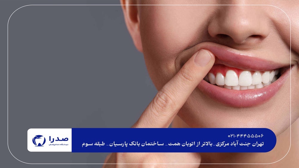 لمینیت و کامپوزیت دندان در جنتآباد لمینیت و کامپوزیت دندان در جنتآباد