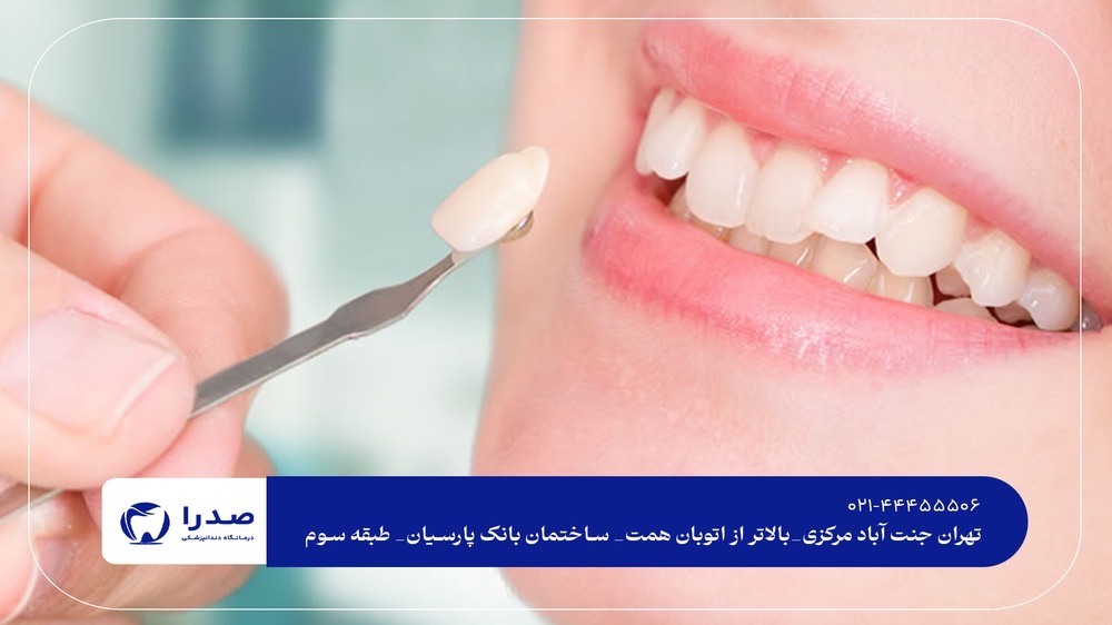 لمینیت و کامپوزیت دندان در جنتآباد لمینیت و کامپوزیت دندان در جنتآباد