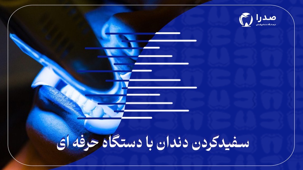 سفید کردن دندان با دستگاه حرفهای سفید کردن دندان با دستگاه حرفهای