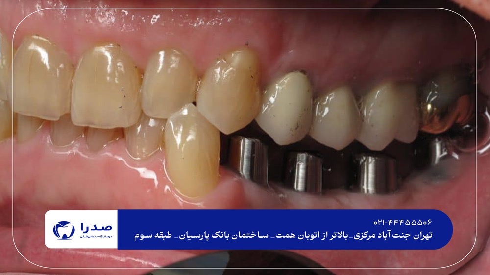 نکات مهم مراقبتی بعد از ایمپلنت نکات مهم مراقبتی بعد از ایمپلنت