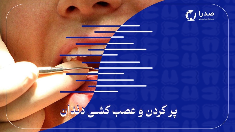 پرکردن و عصب‌کشی دندان