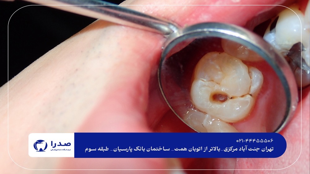 پرکردن و عصب‌کشی دندان