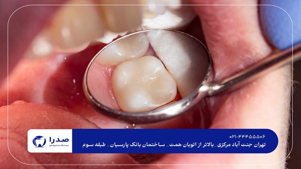 پرکردن و عصب‌کشی دندان