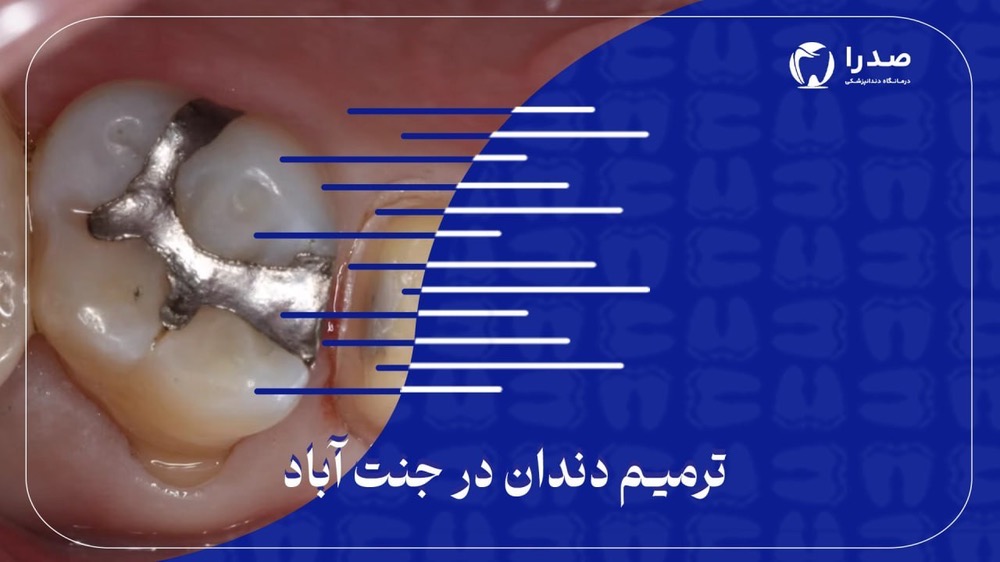 ترمیم دندان در جنتآباد ترمیم دندان در جنتآباد