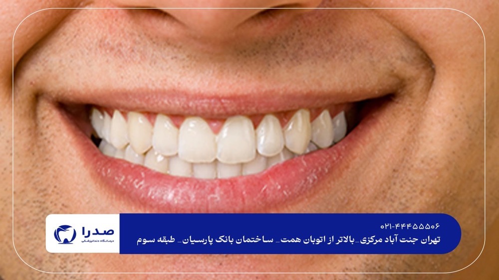 لمینیت دندان در جنتآباد لمینیت دندان در جنتآباد