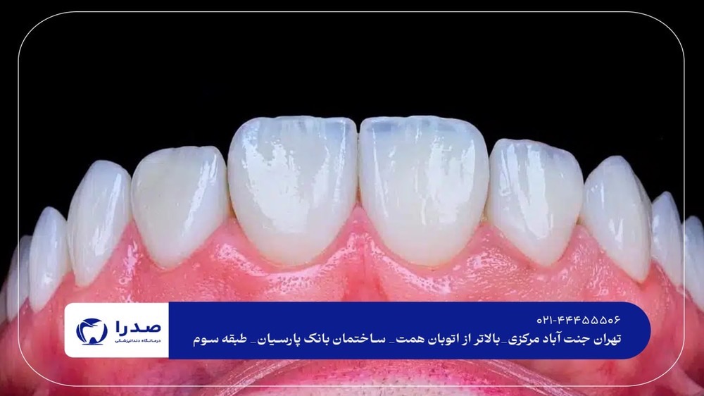 لمینیت دندان در جنتآباد لمینیت دندان در جنتآباد