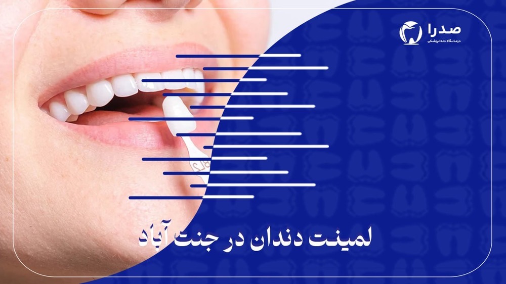 لمینیت دندان در جنتآباد لمینیت دندان در جنتآباد