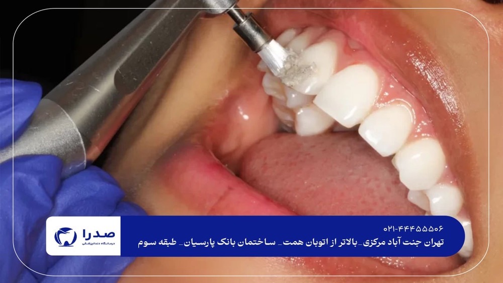 لمینیت دندان در جنتآباد لمینیت دندان در جنتآباد