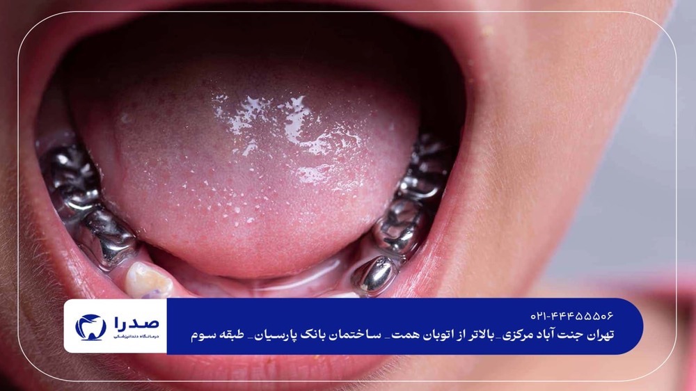 ترمیم دندان شیری ترمیم دندان شیری