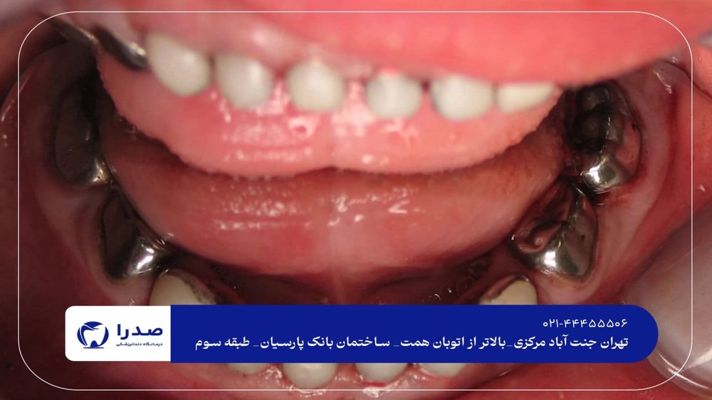 ترمیم دندان شیری ترمیم دندان شیری