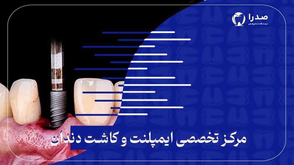 مرکز تخصصی ایمپلنت و کاشت دندان