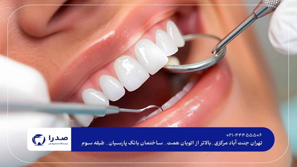  کامپوزیت و لمینت دندان