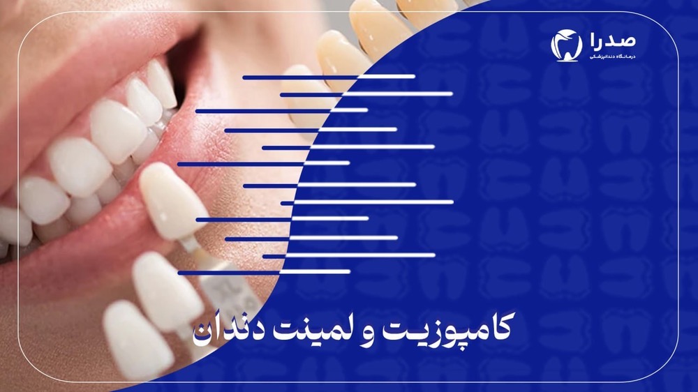  کامپوزیت و لمینت دندان