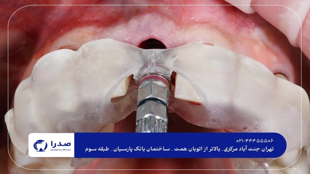 دندانپزشکی تخصصی ایمپلنت دندانپزشکی تخصصی ایمپلنت