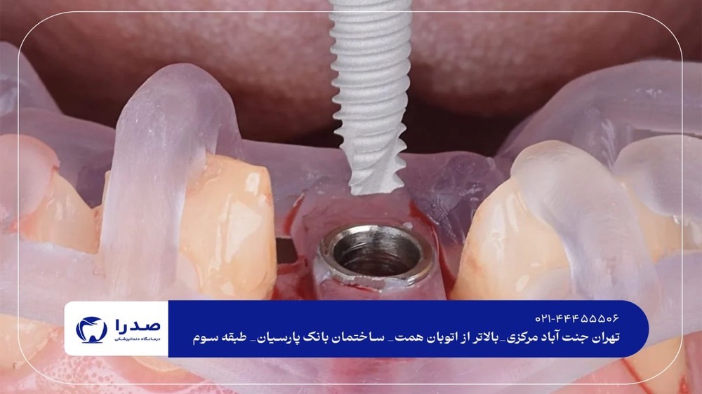 دندانپزشکی تخصصی ایمپلنت دندانپزشکی تخصصی ایمپلنت