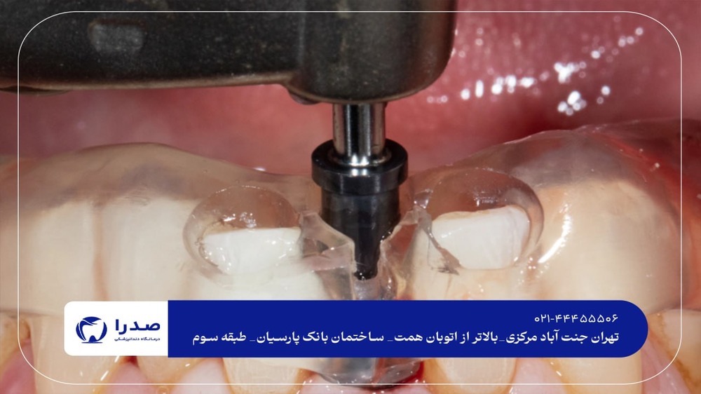 دندانپزشکی تخصصی ایمپلنت دندانپزشکی تخصصی ایمپلنت
